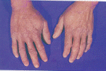 ภาพโรงไข้ดำที่มือ